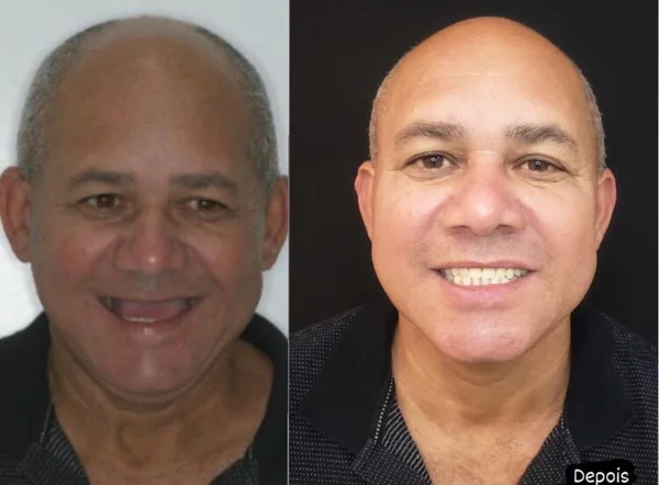 Seu Carlos, antes e depois do implante dentário