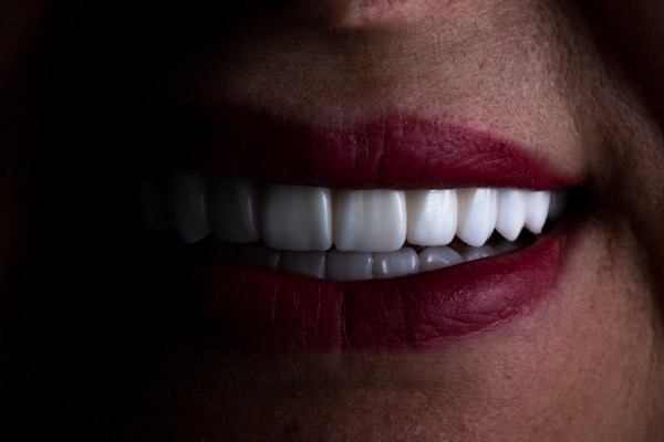Lentes de contato dental em Cabo Frio