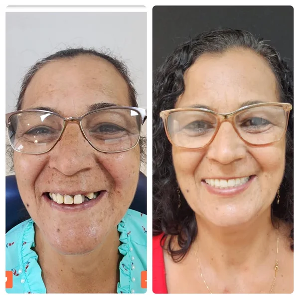 Antes e depois de implante dentário