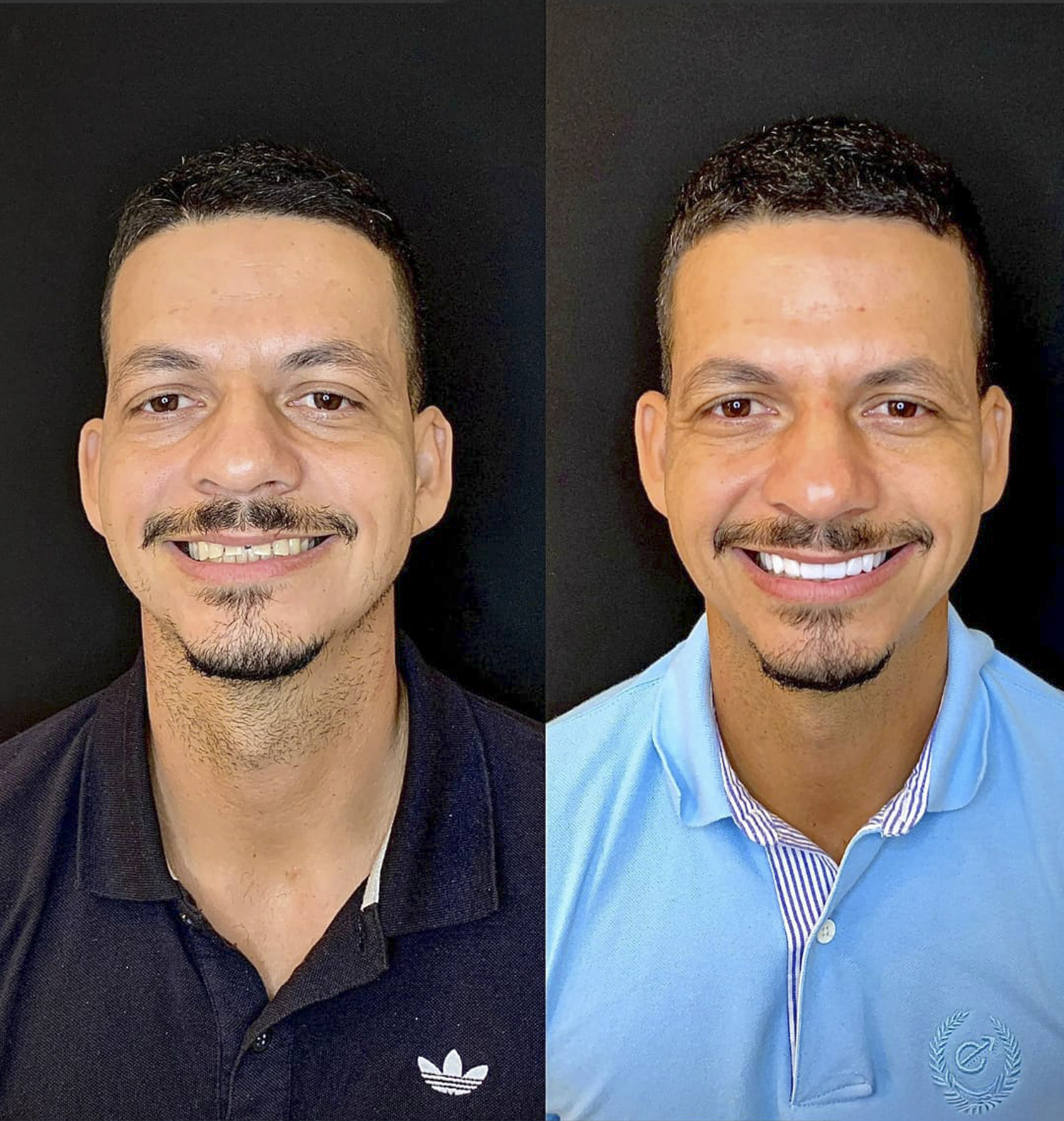 Marcos, antes e depois das lentes de contato dental