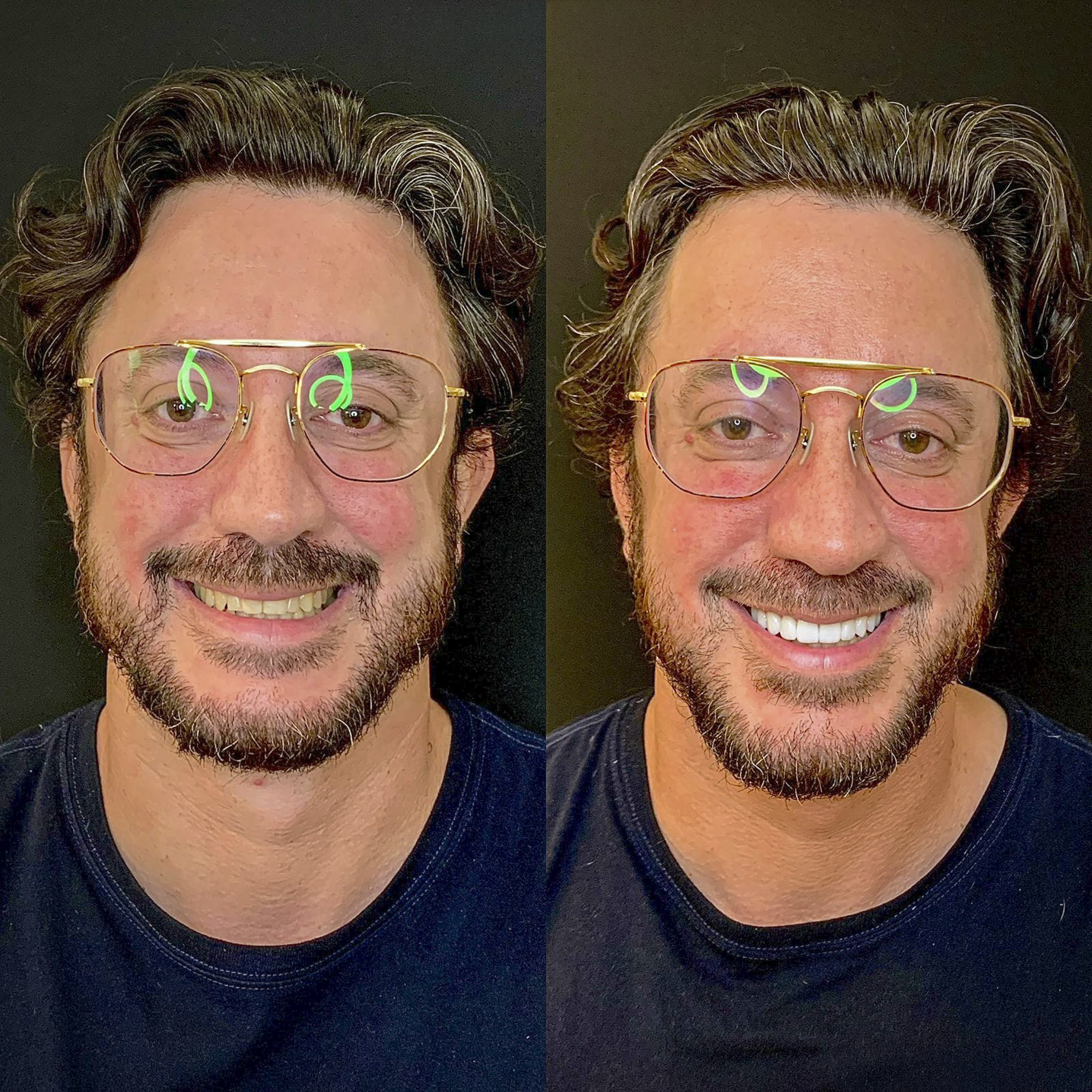 Antes e depois de lentes de contato dental