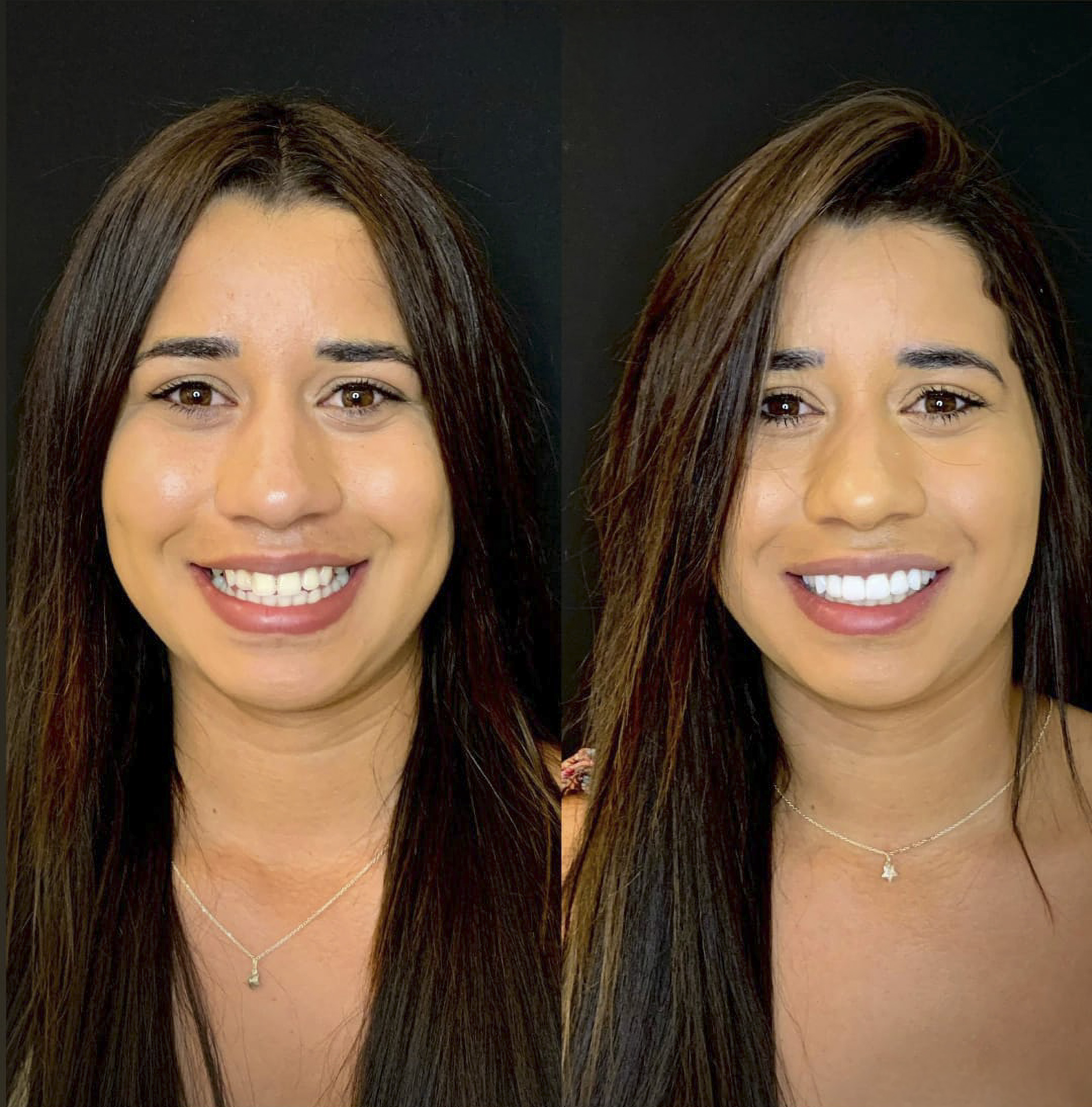 Antes e depois de lentes de contato dental