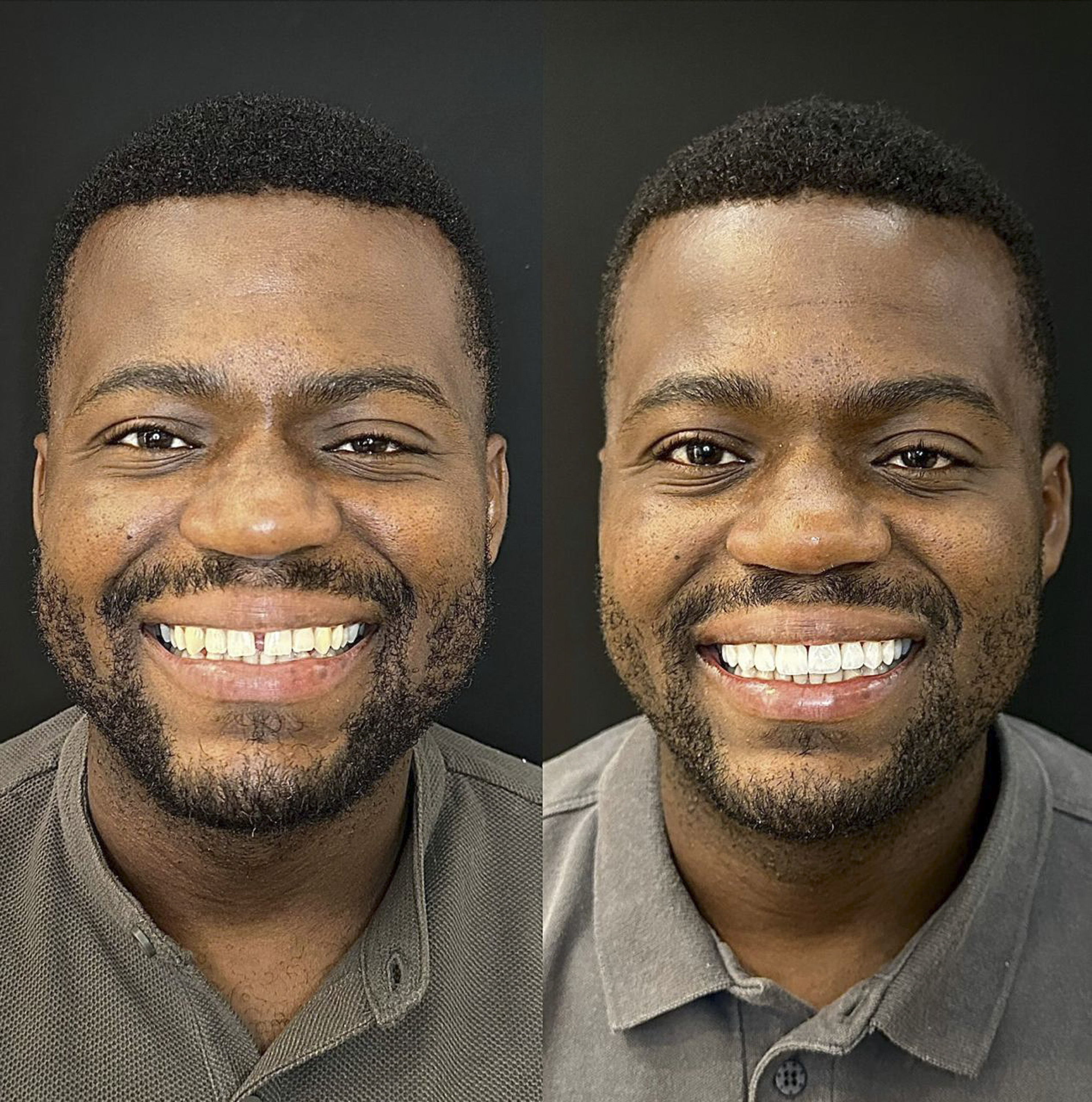 Lucas, antes e depois das lentes de contato dental